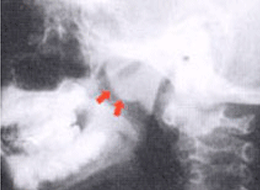 측면 방사선 촬영으로 관찰되는 
				비대한 아데노이드 소견 