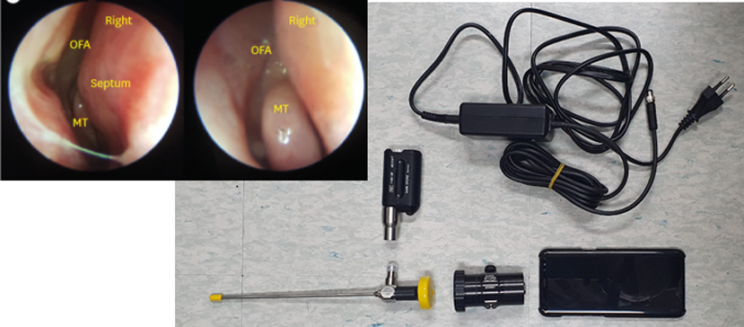 Smart Scope system (Karl Storz)과 스마트폰을 이용하여 촬영한 내시경 소견