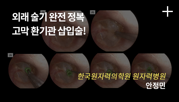외래 술기 완전 정복 고막 확기관 삽입술