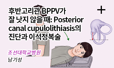 후반고리관 BPPV가 잘 낫지 않을 때: Posterior canal cupulolithiasis의 진단과 이석정복술 / 조선대학교병원 남기성